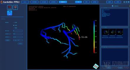 生物流體力學(xué)賦能精準醫(yī)療，晟視科技近億元Pre-A輪融資引領(lǐng)超聲技術(shù)創(chuàng)新